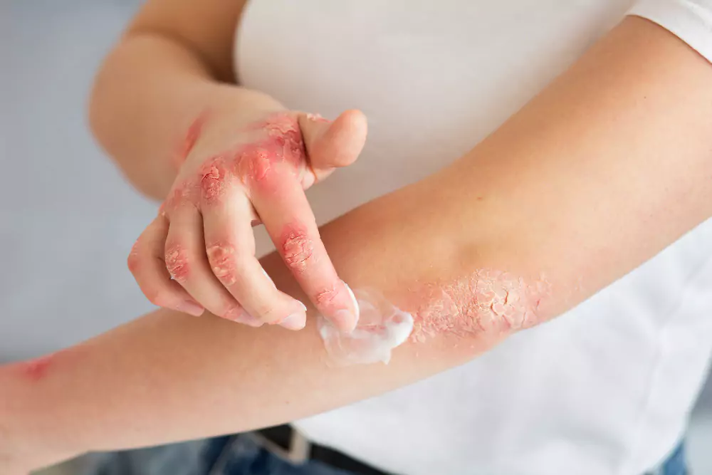 Psoriasis Treatment