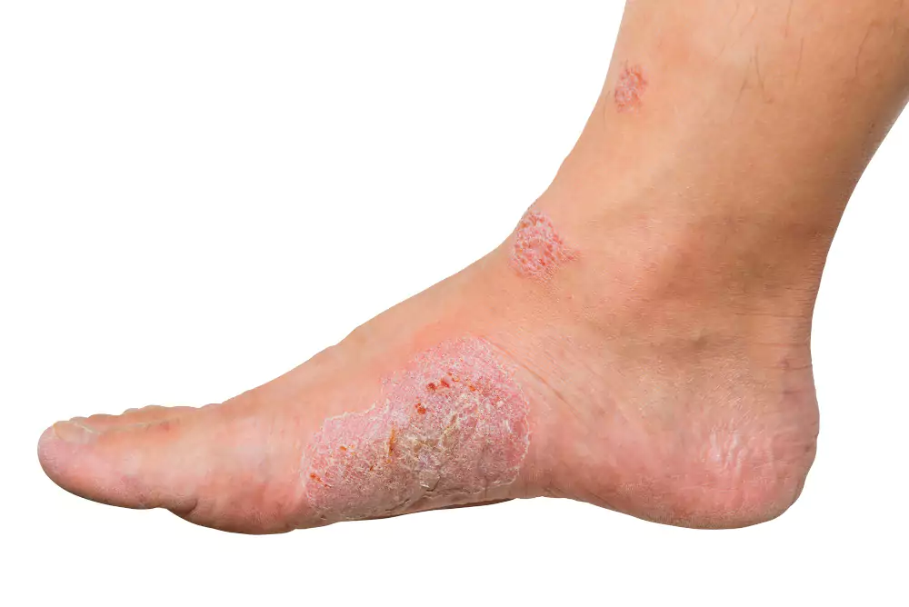Fungal Infection