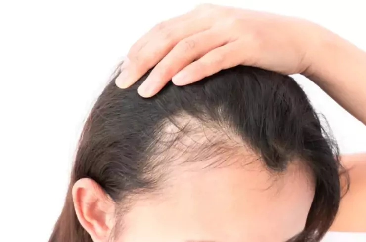 Alopecia (Male/Female Pattern Baldness)