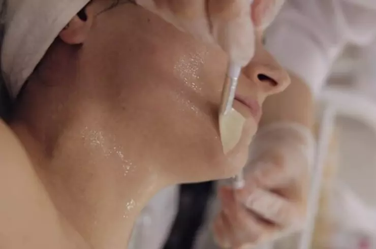 Chemical Peels