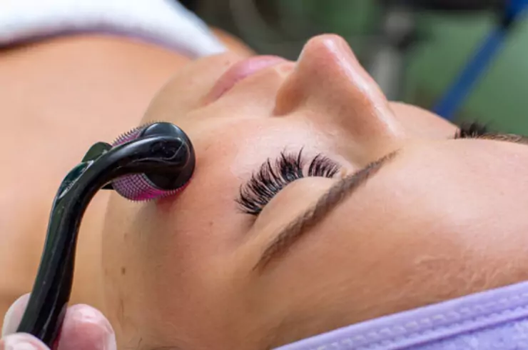 Dermaroller Treatment