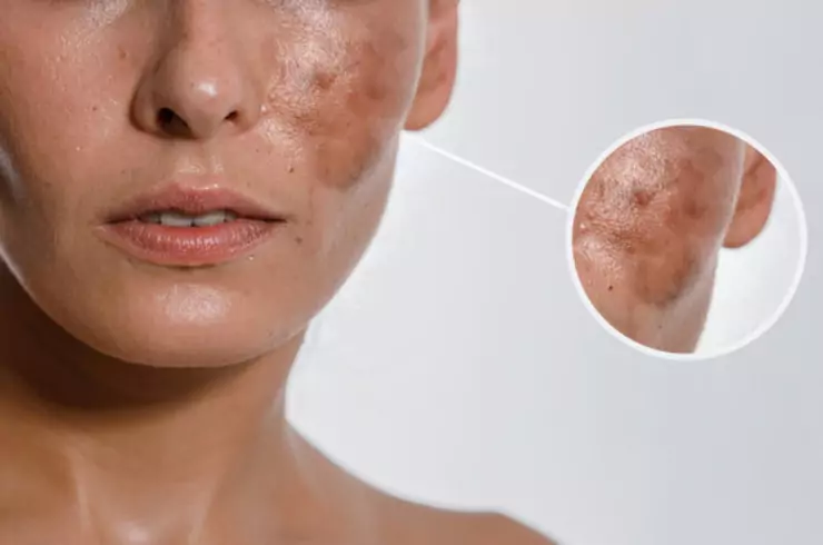Melasma / Pigmentation Treatment