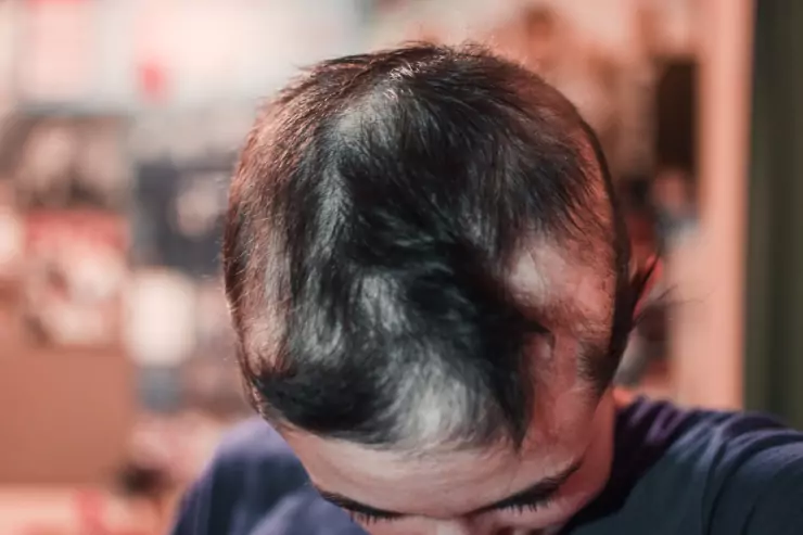 Patchy Hair Loss
