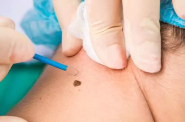 Skin Tag / Wart Removal